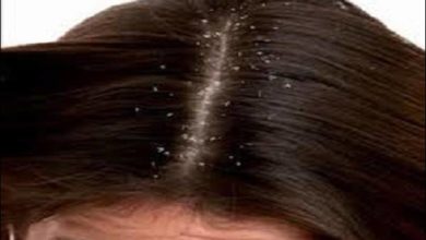 علاج قشرة الشعر