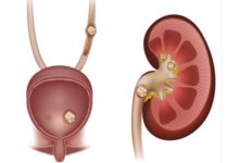 حصوات الكلى